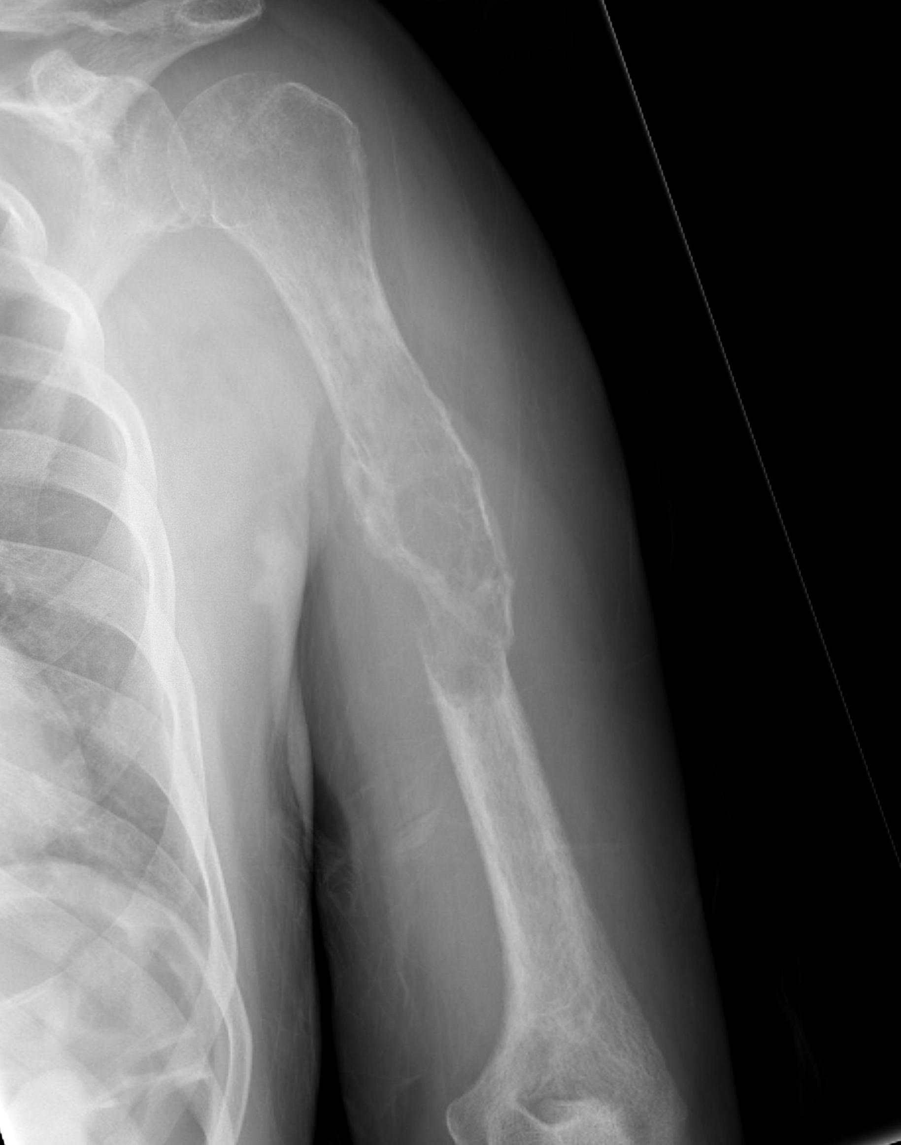 Metastasis Humerus Plate PMMA0001